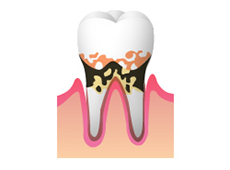 中度から重度の歯周炎