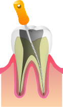 根管治療の方法