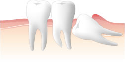 親知らずの抜歯